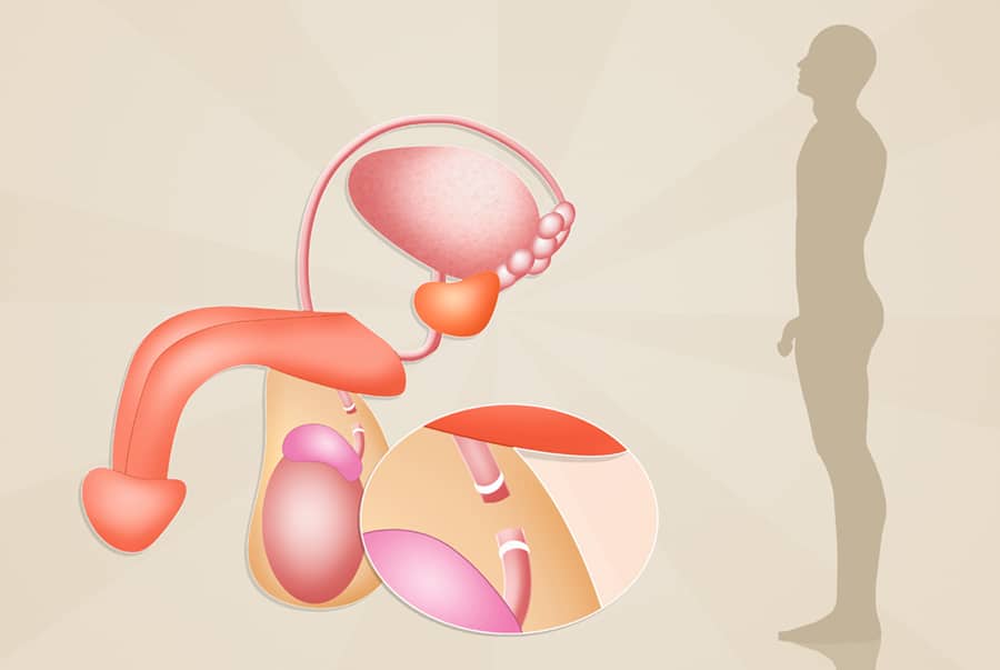 vasektomia mužska antikoncepcia